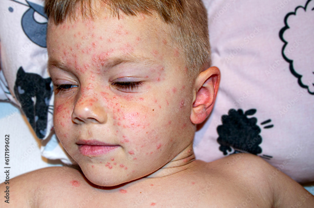 Foto de Natural vaccination. Contagious disease. Sick child with