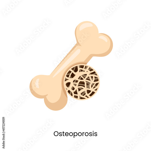 bone osteoporosis health problem medical disease sponge anatomy arthritis