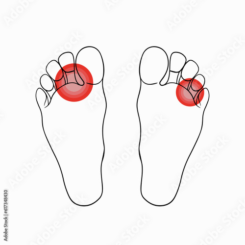 Vector isolated illustration of foot fungus. Contour drawing of foot fungus. Foot hygiene. Discomfort, itching of the fungus.