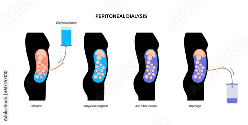 Peritoneal dialysis concept