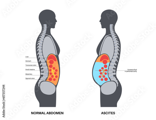 Ascites disease poster