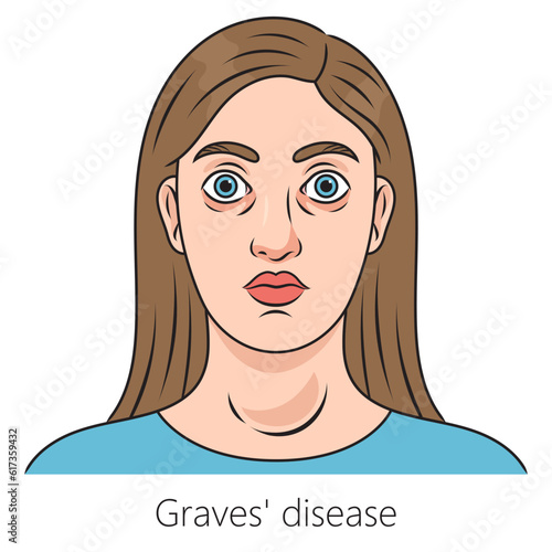Woman with Graves disease toxic diffuse goiter diagram schematic vector illustration. Medical science educational illustration