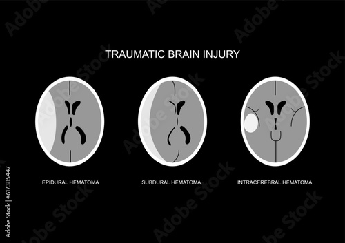 Illustration of common CT imaging following traumatic brain injury. Epidural hematoma, acute subdural hematoma and intra-cerebral hematoma. photo