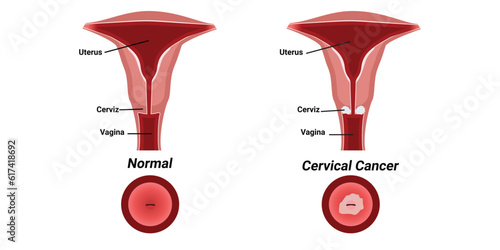 Illustration of cervical cancer vector