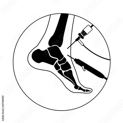 Ankle arthroscopy poster
