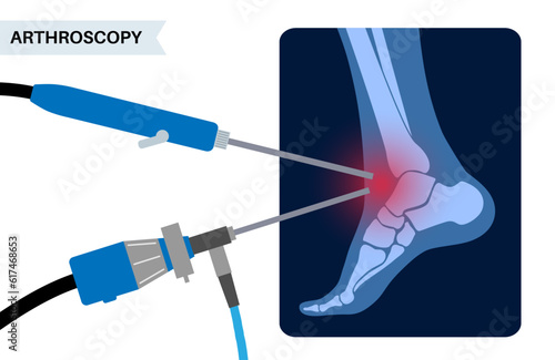 Ankle arthroscopy poster