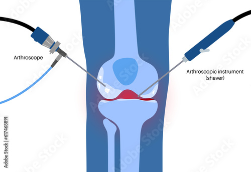 Knee joint arthroscopy