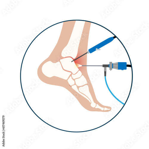 Ankle arthroscopy poster