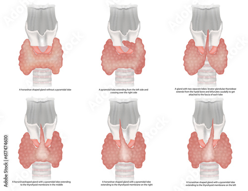Illustration of the classification of the thyroid gland shapes. The anatomical variations and types of thyroid gland and Pyramidal lobe. Morphological features pyramidal lobe