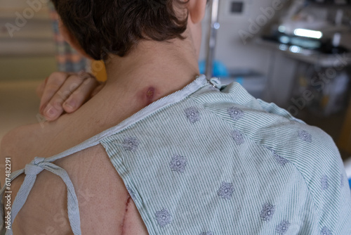 Child with staph infection following spinal fusion surgery; boy wearing medical gown.  Infected incision.