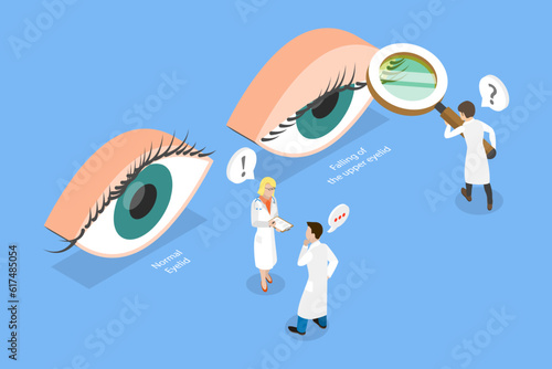 3D Isometric Flat Vector Conceptual Illustration of PTOSIS, Srooping of the Upper Eyelid