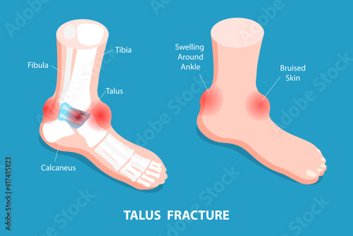 3D Isometric Flat Vector Conceptual Illustration of Talus Fracture, Ankle Trauma