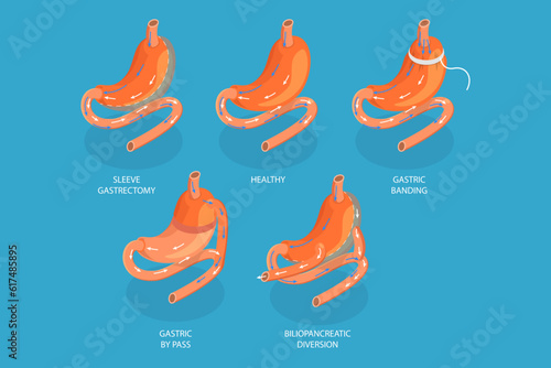 3D Isometric Flat Vector Conceptual Illustration of Types Of Bariatric Surgery, Sleeve Gastrectomy