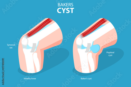 3D Isometric Flat Vector Conceptual Illustration of Bakers CYST, Traumatology and Prthopedics