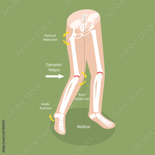 3D Isometric Flat Vector Conceptual Illustration of Mechanism Of Acl Injury, Labeled Educational Diagram