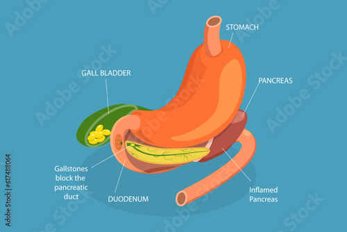 3D Isometric Flat Vector Conceptual Illustration of Acute Pancreatitis, Digestive System Issues