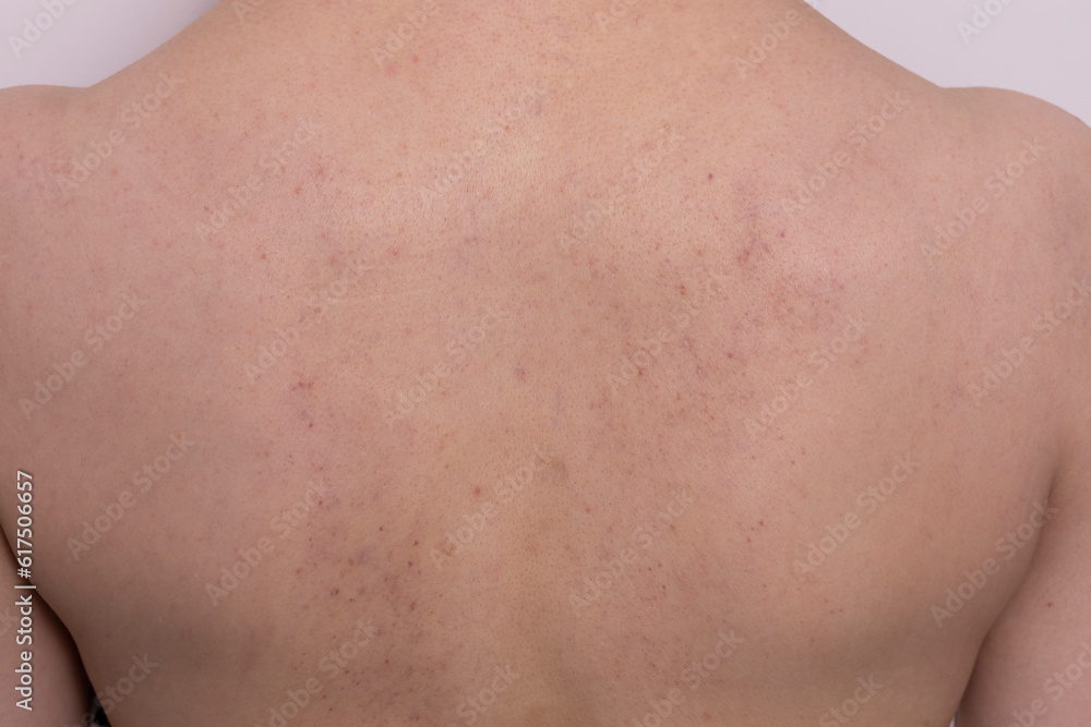 Close up bruises, broken capillaries after cupping, anti cellulite massage procedure on female back. Feeling unwell, Bad Effect, consequences after massage. Complications. Horizontal Plane Close up bruises, broken capillaries after cupping, anti cellulite massage procedure on female back. Feeling unwell, Bad Effect, consequences after massage. Complications. Horizontal Plane