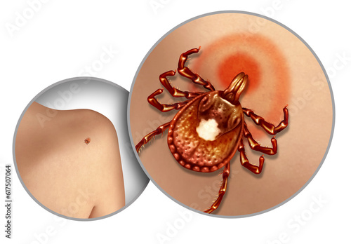 Fotografia Lone Star Tick on the skin as a disease and infectious ticks spreading infection