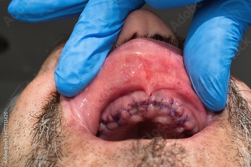 Upper male palate with the gum stitched after the extraction of the incisor teeth.