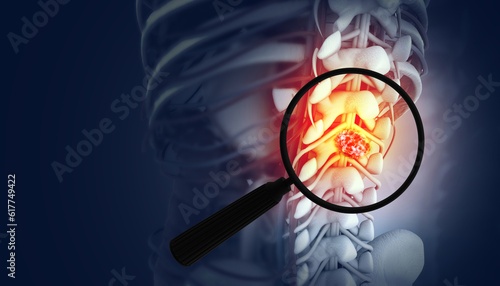 Quadro em tela Magnifying glass showing the spine cancer or spinal tumor disease