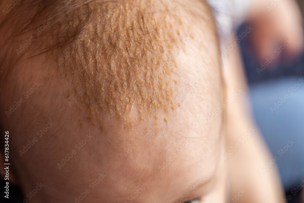 Seborrheic dermatitis on the skin on the head of a 6 month old baby. Yellow scales on the head, close-up - obrazy, fototapety, plakaty 