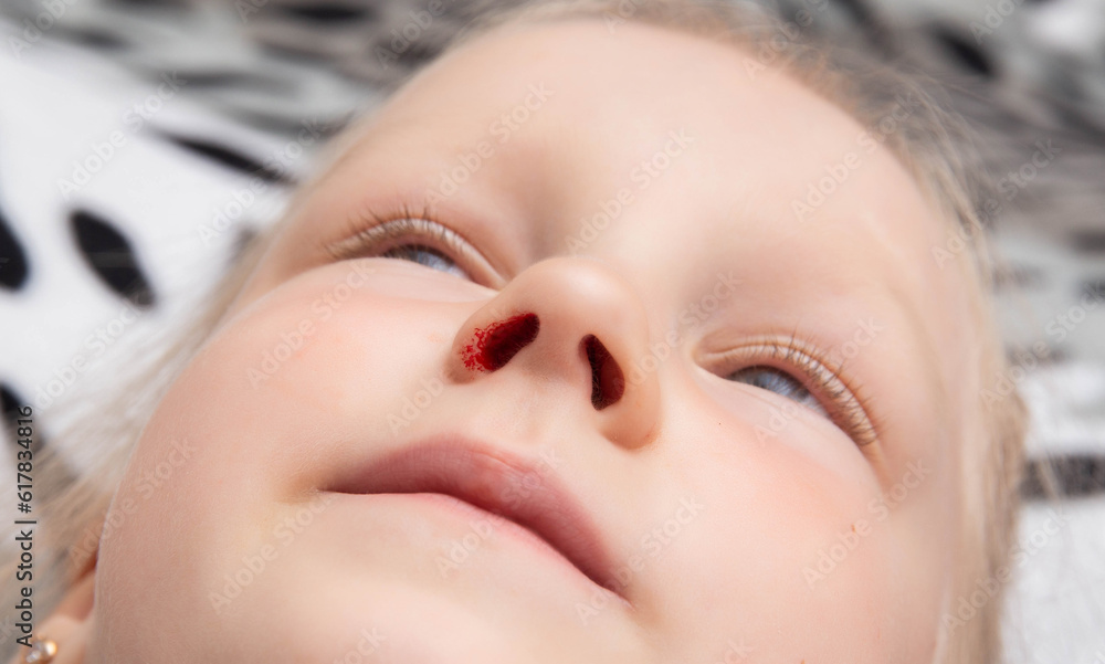 The face of a little caucasian girl with a nosebleed. Nosebleeds in children as a symptom, trauma. The face of a little caucasian girl with a nosebleed. Nosebleeds in children as a symptom, trauma.