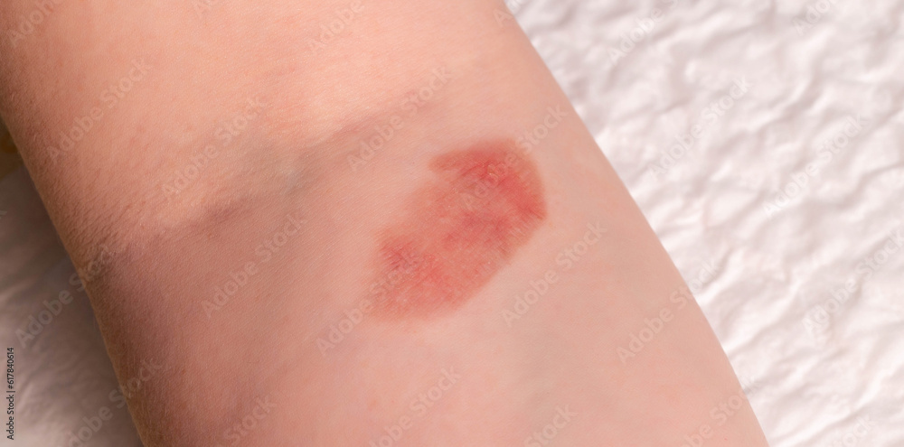 Red spot on the skin, skin damage from a burn on the arm. Close-up Red spot on the skin, skin damage from a burn on the arm. Close-up