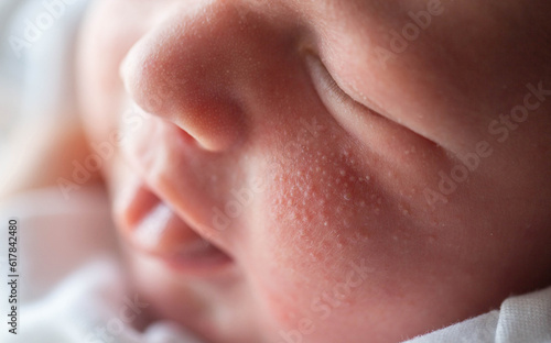 Pimples on the face of a newborn. Baby's adaptation to the environment, close-up photo
