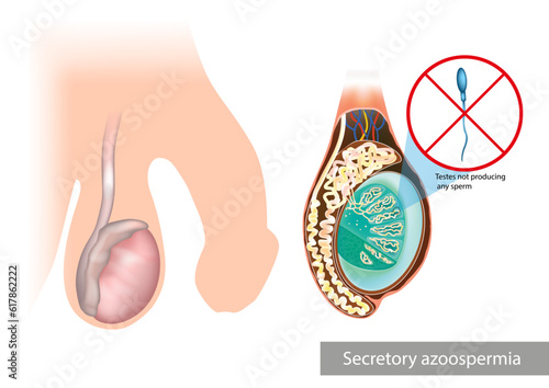 Secretory or Non-Obstructive Azoospermia.Testes not producing any sperm. Testicular problems