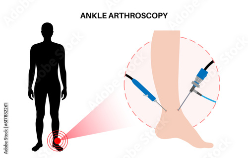 Ankle arthroscopy poster