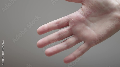 dermatitis, psoriasis eczema and dry skin of palm hands, itchy inflammatory condition. round spots, coin-shaped lesions, small blisters and cracks occur discoid eczema. dermatological illness consept photo