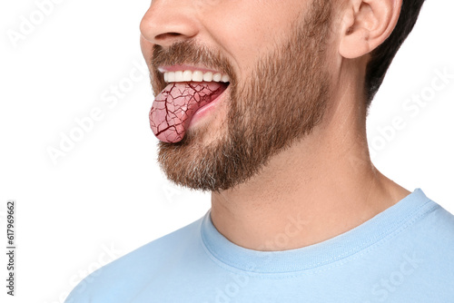 Dry mouth symptom. Man showing dehydrated tongue on white background, closeup photo