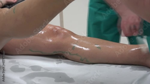 Varicose Veins on a patient photo