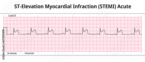 ST-Elevation Myocardial Infarction (STEMI) Acute - 8 Second ECG Paper - Electrocardiography Vector Medical Illustration