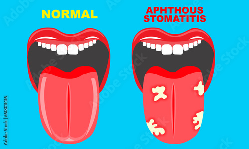 illustration of mouth and tongue problems with aphthous stomatitis. symptoms of oral disease Fungi on the tongue
