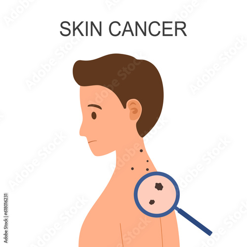 Skin cancer disease on man skin in flat design.
