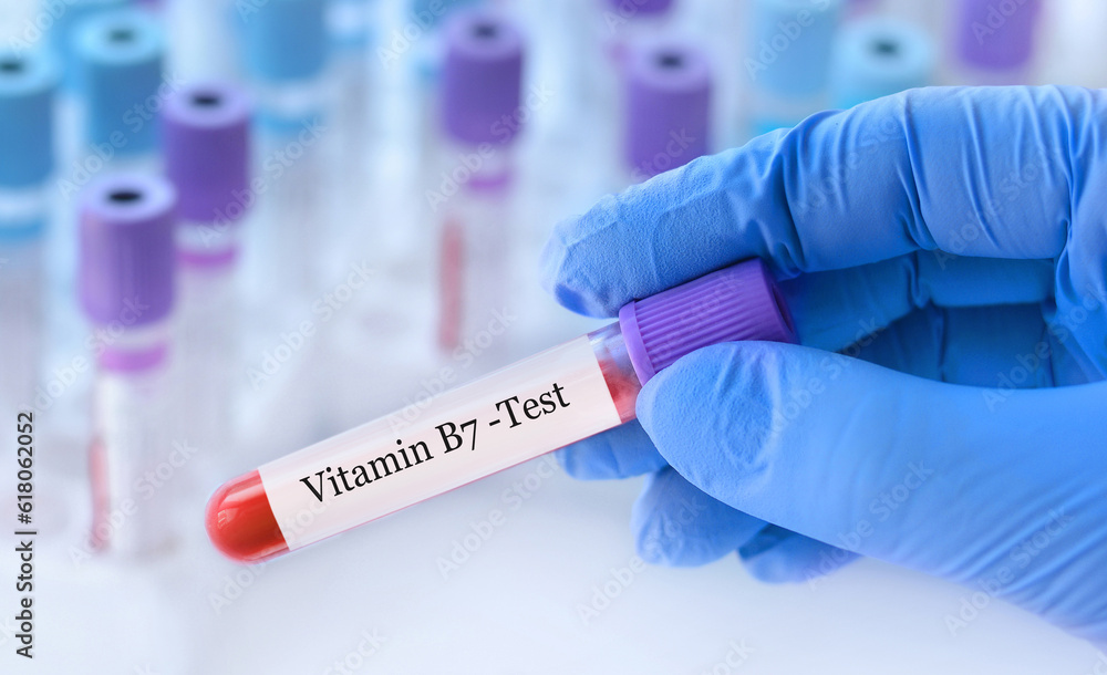 Doctor holding a test blood sample tube with Vitamin B7 test on the background of medical test tubes with analyzes