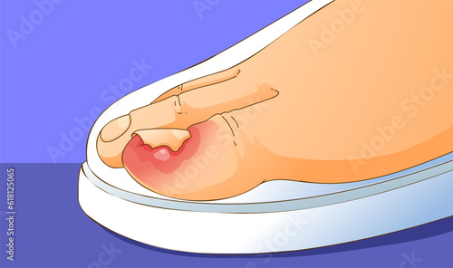 Finger with an ingrown toenail. Uncomfortable shoes. Healthcare illustration. Vector illustration. photo
