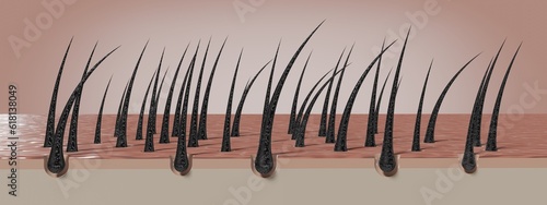 Canvastavla Dried and damaged hair follicles - 3D illustration