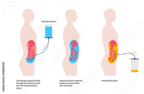 Peritoneal dialysis concept