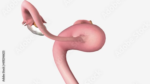 Stage 2 ovarian cancer means the cancer has grown outside the ovaries and is growing within the pelvis.