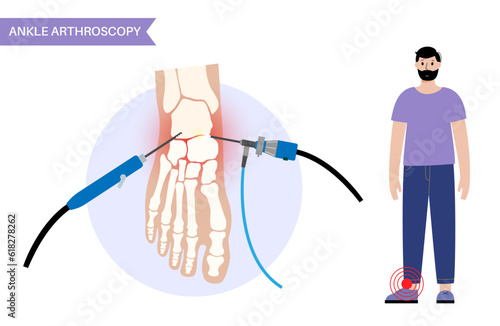 Ankle arthroscopy poster
