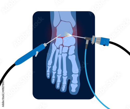 Ankle arthroscopy poster