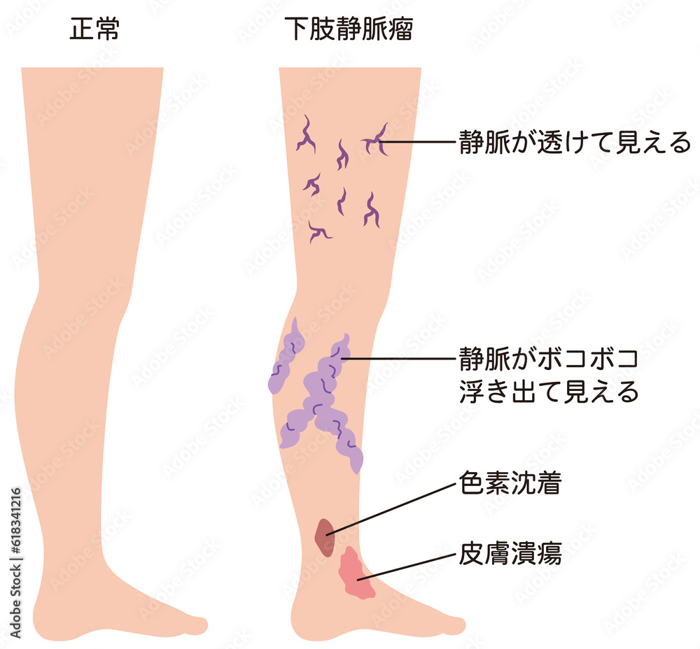 Obraz premium 下肢静脈瘤 血管の病気 医療