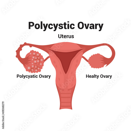 Illustration of Polycystic ovary vector