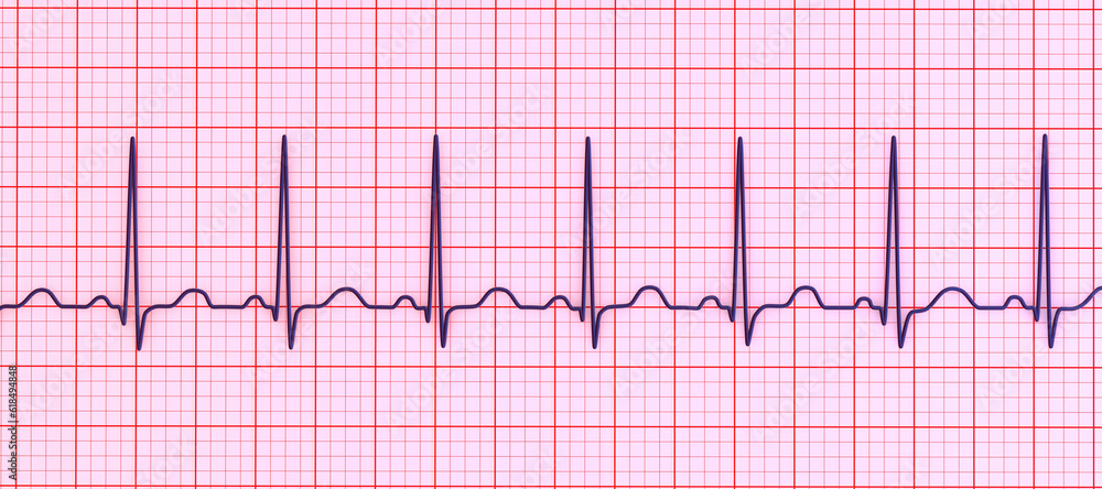 Electrocardiogram ECG displaying sinus tachycardia, 3D illustration Electrocardiogram ECG displaying sinus tachycardia, 3D illustration