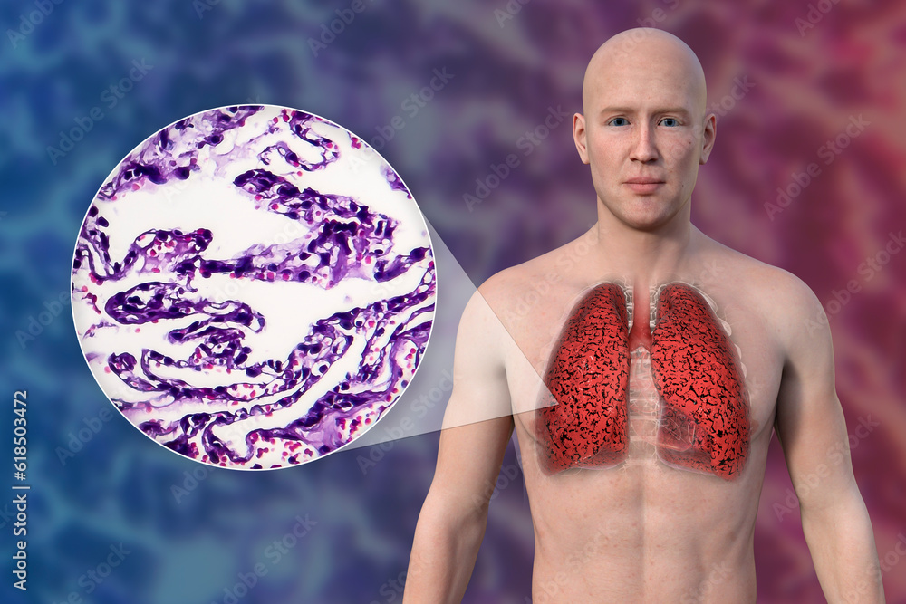 Naklejka premium A 3D illustration of the upper half part of a man with transparent skin, revealing the condition of smoker's lungs