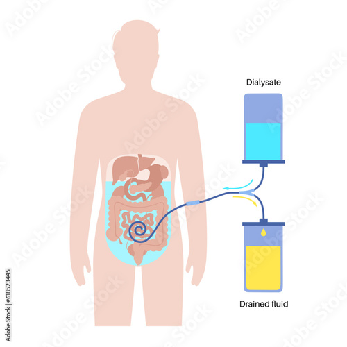 Peritoneal dialysis concept