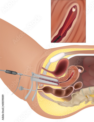Uterine Polyps or Endometrial Polyps. Diagnostic Hysteroscopy. Procedure