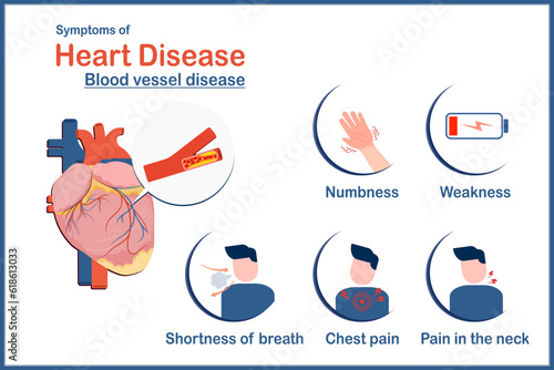 Medical illustration vector concept,symptoms of heart disease caused by atherosclerosis,numbness,chest pain,weakness,shortness of breath and neck pain.flat style